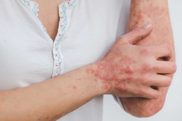 Spezialsprechstunde für Psoriasis-Arthritis (PsA)| Rheumatologie am Hofgarten